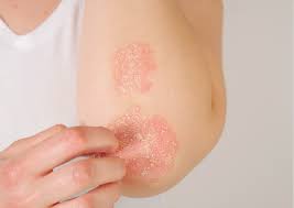 Недавно заметил на локтях красные пятна, которые шелушатся чешутся и болят. Что это?