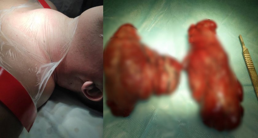 Жителю Кировской области удалили зоб длиной больше 25 сантиметров