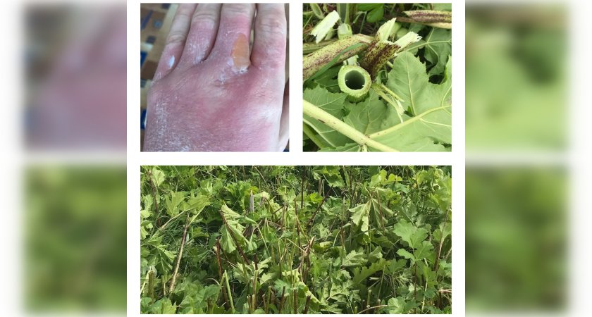 "Борьба не прекращается": житель Кировской области не может победить борщевик на участке