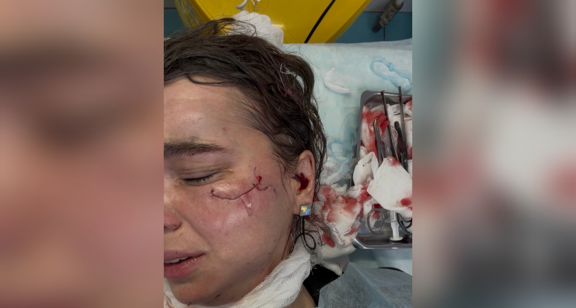 "Лицо изуродовано, стекла убирала с головы еще неделю": кировчанка о последствиях нападения в 5-звездочном отеле Казани