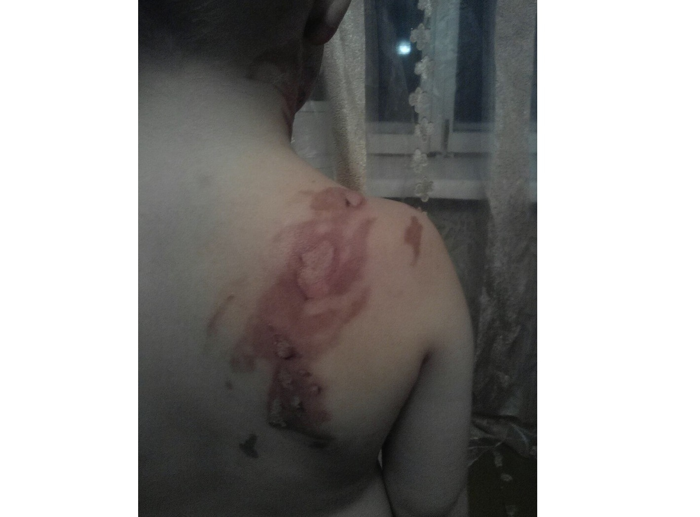 В Кировской области няня пролила на ребенка суп: мальчик получил серьезные ожоги