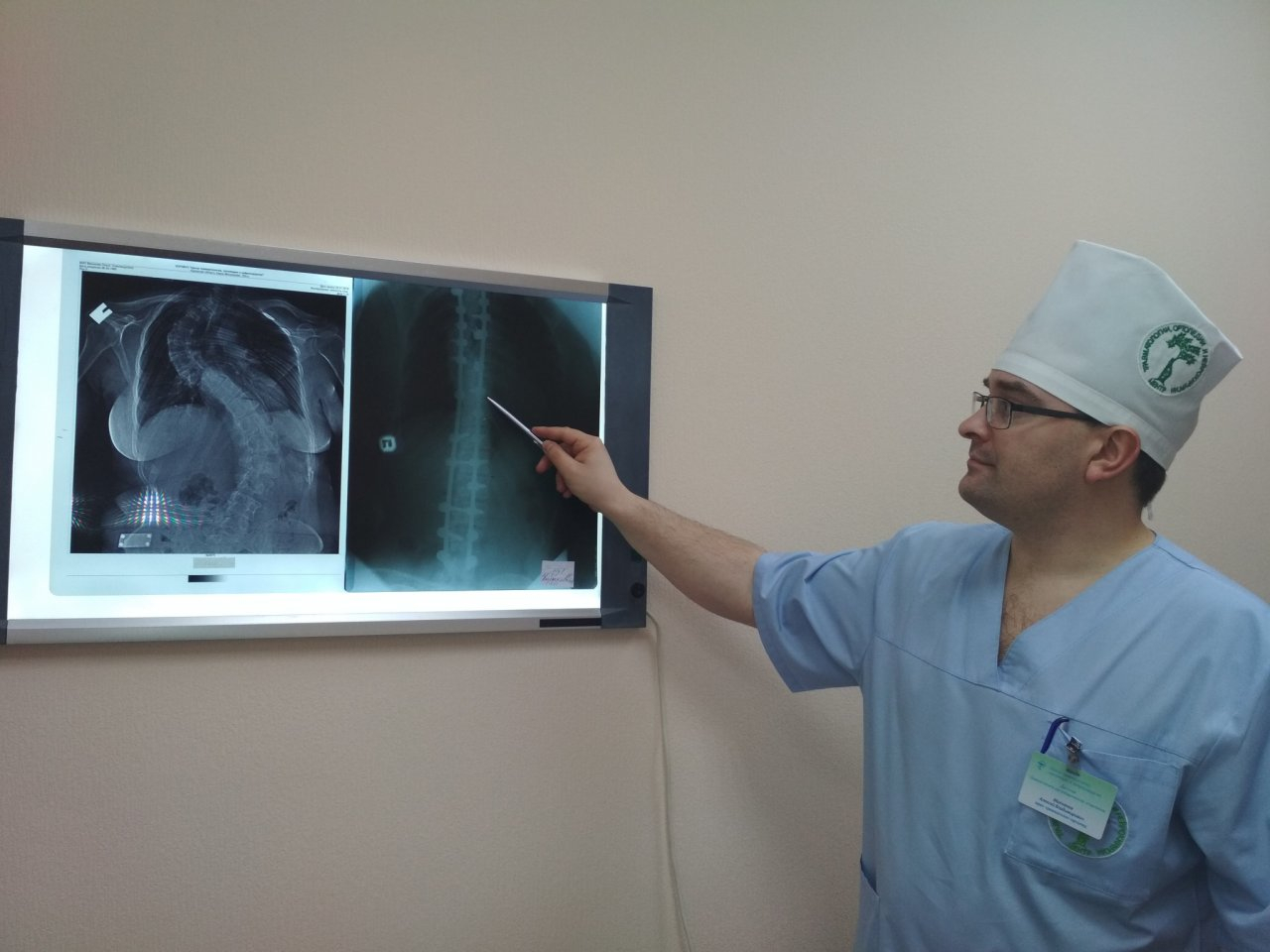 В Кирове пациентке провели несколько сложнейших операций по удлинению конечностей