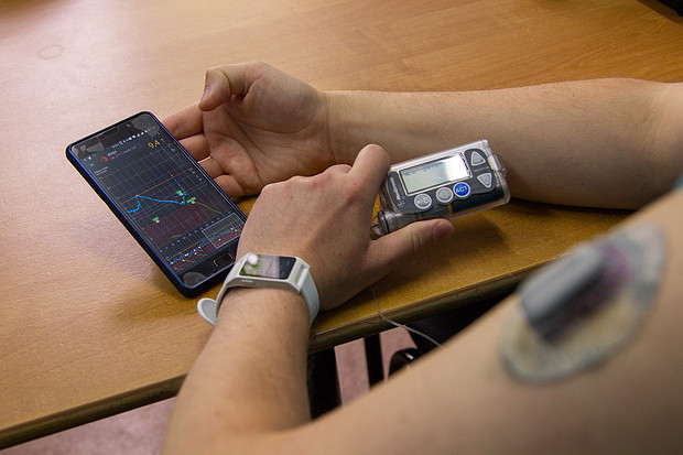 В Кировской области пациентам с сахарным диабетом будут бесплатно выдавать «расходники» для инсулиновой помпы