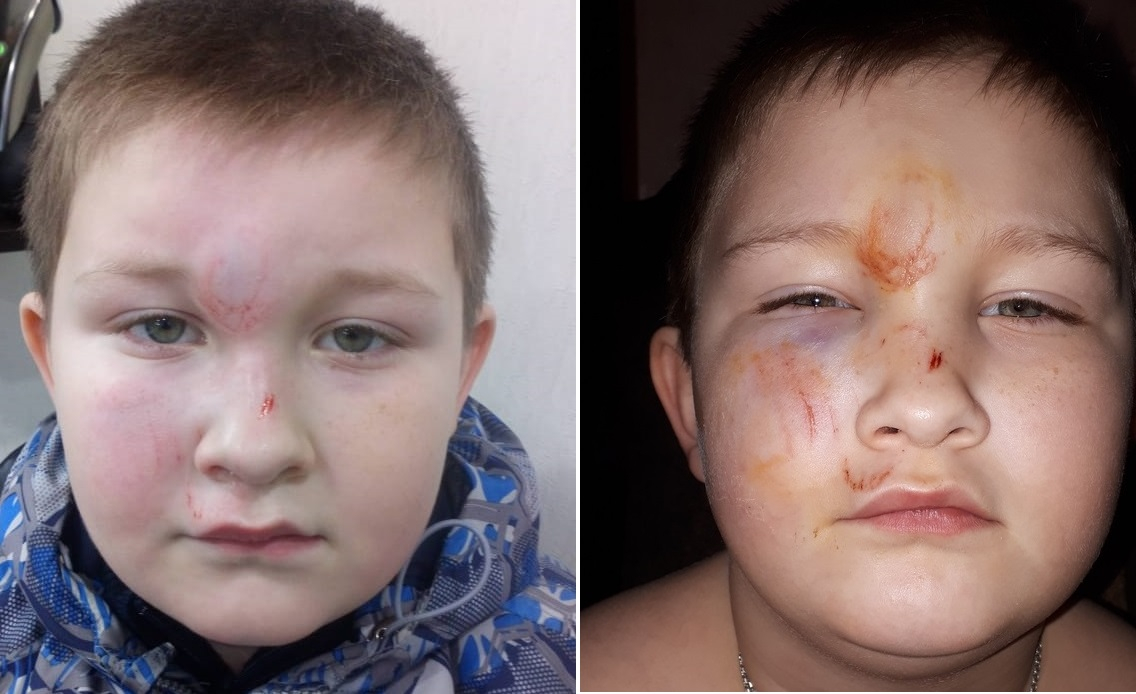В Нолинске 7-летний мальчик разбил лицо, упав на лед возле школы