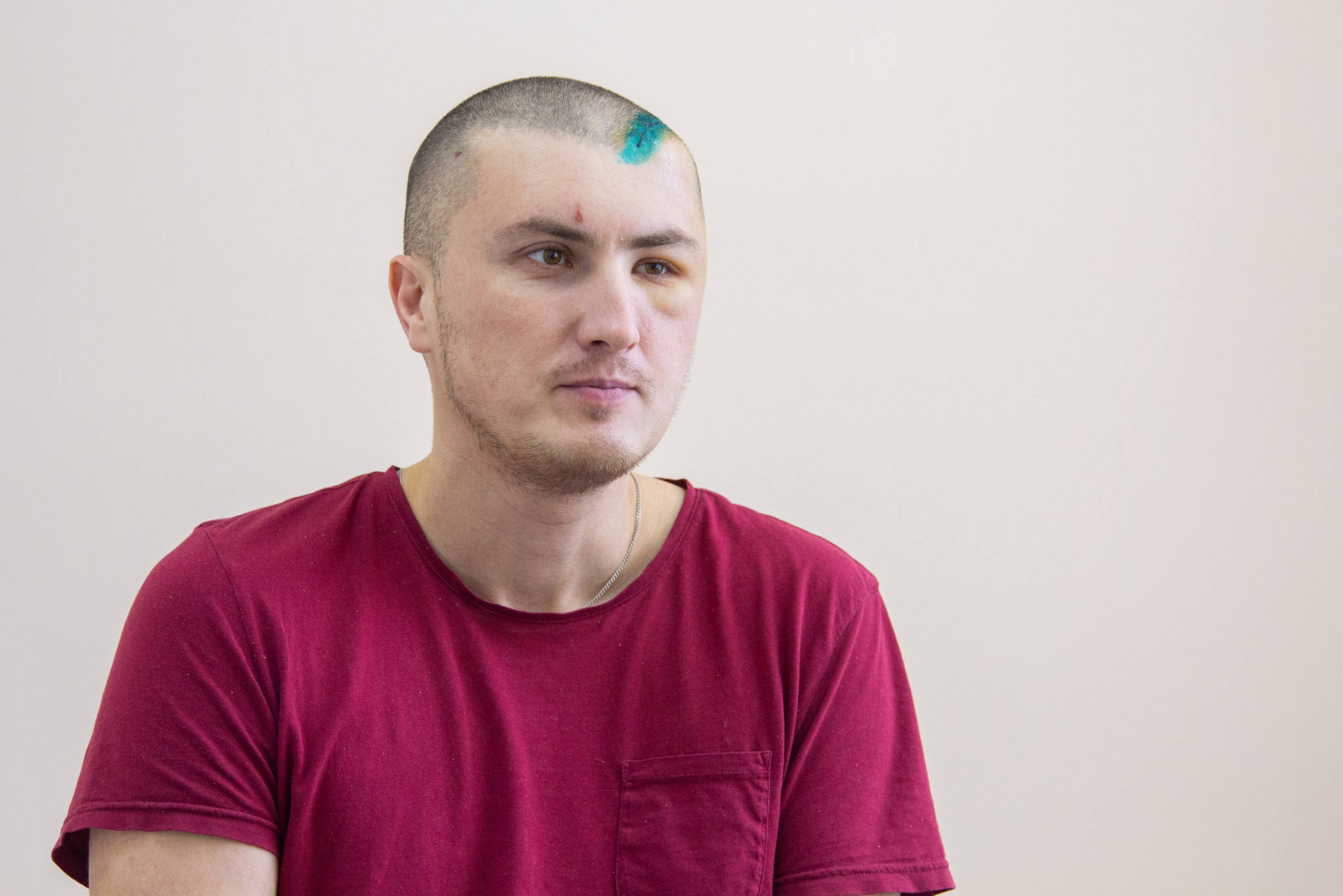 В Кирове 35-летний мужчина с инсультом сам приехал в областную больницу