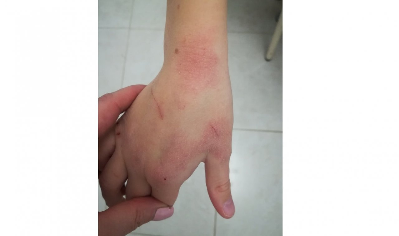 «Руки белые, кожа слезает!»: кировские родители жалуются на качество антисептиков в школах
