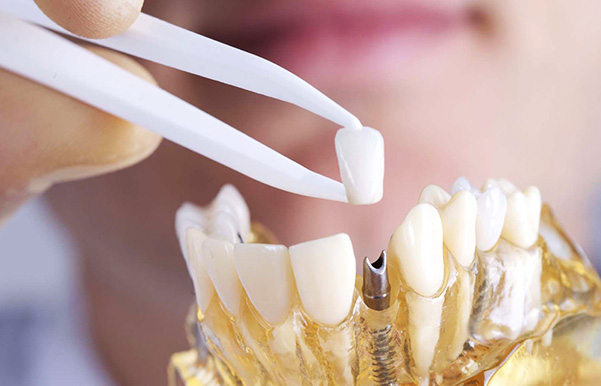 Можно ли устанавливать имплантат зуба при воспалительных процессах?