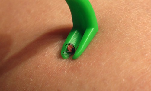 В Кировской области человек заболел гранулоцитарным анаплазмозом после укуса клещом