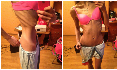 Жертва анорексии: «Я поняла, что больна, когда начала лысеть»