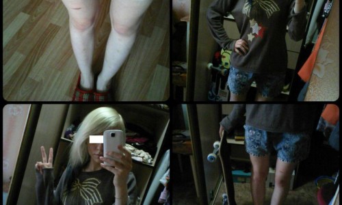 Жертва анорексии: «Врачи махнули на меня рукой»