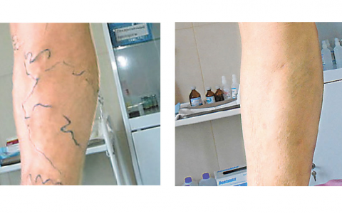 Лечение варикоза без госпитализации