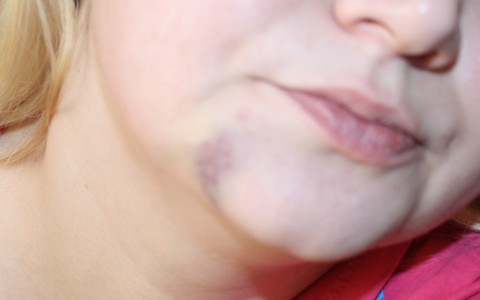 Кировчанка: "Охранник бара ударил меня в челюсть из-за шутки"