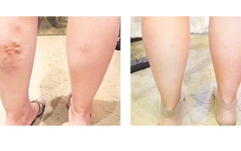 Статистика по варикозу в России пугает