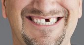 Стоматолог рассказал, почему выбитый зуб нужно класть в молоко