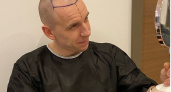 Что такое "волосяной туризм: ведущий рассказал, как пережил операцию по пересадке волос