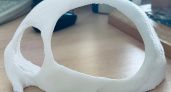 Кировчанину восстановили кости черепа с помощью 3D-печати
