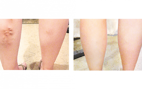 Принимаете контрацептивы? Задумайтесь о венах!