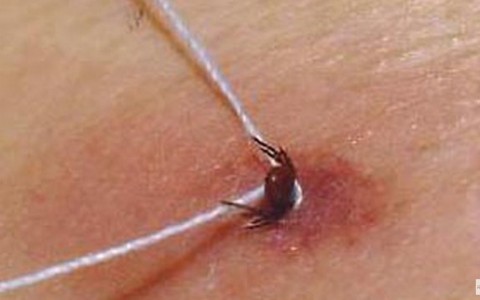 В Кировской области зафиксирован первый случай укуса клеща