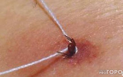 В Кировской области от укусов клещей пострадали 178 человек