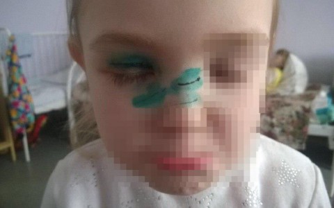 В Кирове домашняя кошка напала на девочку и разорвала ей веко