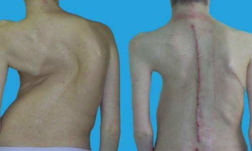 В кировской «травме» делают уникальные операции на позвоночнике у детей