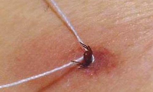 В этом году клещи покусали более 12 000 кировчан