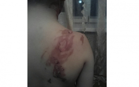 В Кировской области няня пролила на ребенка суп: мальчик получил серьезные ожоги