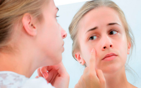 Угри: как справиться с главной проблемой подростков?