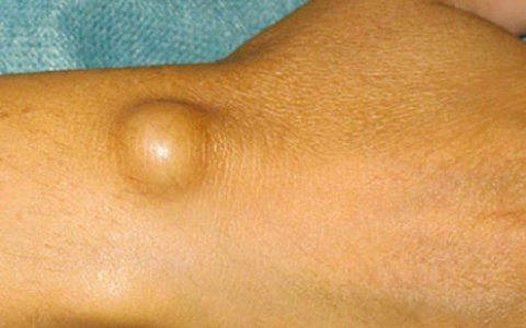 Удаление липомы (жировика) в Центре диагностики и лечения "Лайт"