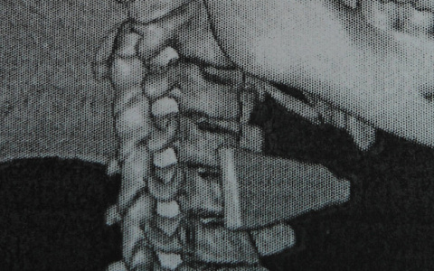 Кировские хирурги удалили осколок стекла из шеи 9-летнего ребенка