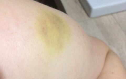 Девушка пострадала на аттракционе у цирка в Кирове