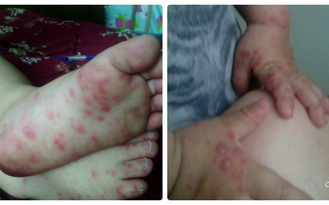 Кировчанка: "В инфекционной больнице ребенка заразили экзотической ветрянкой"