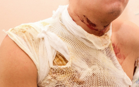 В Кировской области мужчина получил ожоги 50 процентов тела и смог вызвать себе скорую