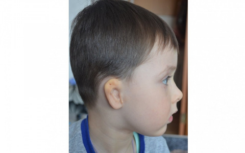 В Пижанке родился мальчик без ушного прохода