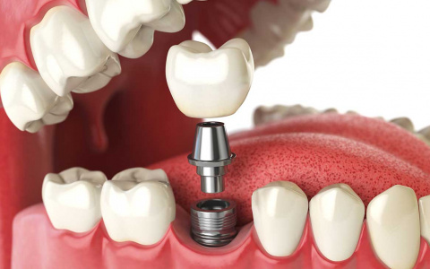 4 ошибочных суждения о протезировании зубов