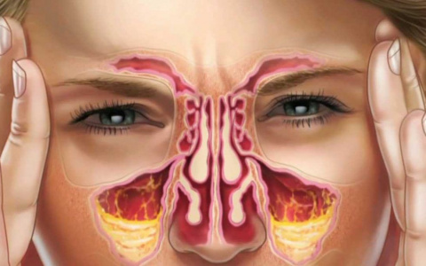 Что такое острый гайморит