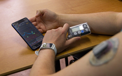 В Кировской области пациентам с сахарным диабетом будут бесплатно выдавать «расходники» для инсулиновой помпы