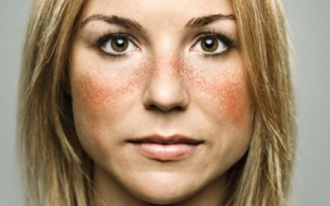 Красная волчанка: «солнечная» болезнь, о которой должен знать каждый