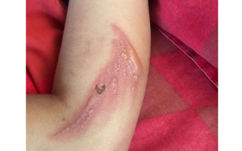 В кировском дворе ребенок получил ожог от борщевика