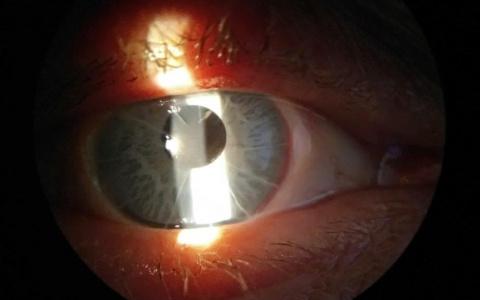 Кировские врачи провели первую операцию по имплантации радужки глаза