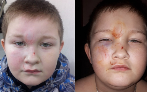 В Нолинске 7-летний мальчик разбил лицо, упав на лед возле школы