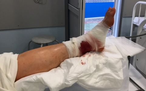 Кировчанка получила двойной перелом, поскользнувшись на льду