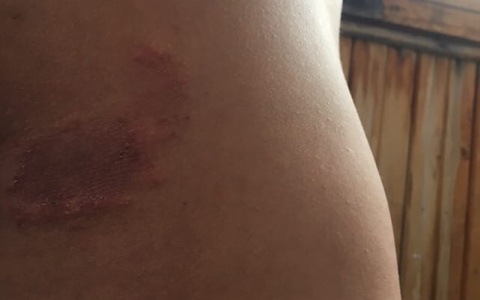 Кировчане массово жалуются на появление странных пятен после купания на карьерах у Нового моста