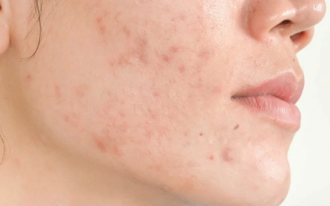 Прыщи: специалисты о причинах и способах решения проблемы