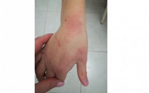 «Руки белые, кожа слезает!»: кировские родители жалуются на качество антисептиков в школах