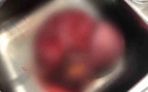 Опухоль весом 5,5 кг: кировские онкологи провели сложнейшую операцию