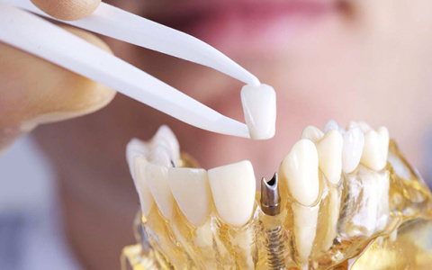 Можно ли устанавливать имплантат зуба при воспалительных процессах?