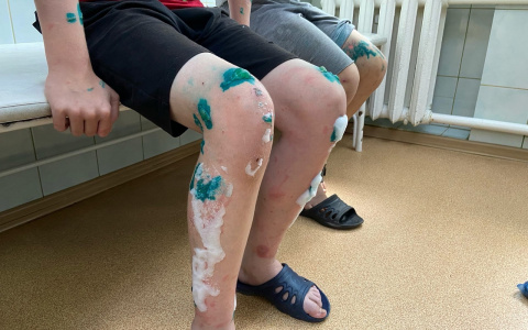 В Кировской области выявлены массовые случаи серьезных ожогов детей борщевиком