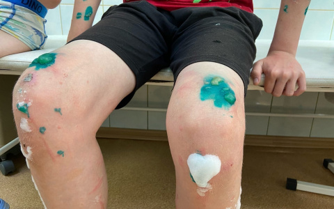 Что обсуждают в Кирове: три случая ожогов борщевиком у детей и ДТП на трассе