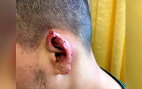 В Кировской области в драке молодому человеку откусили ухо